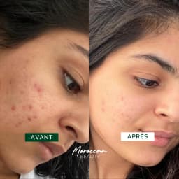 Acne Treat+ Routine - Cleans pores & Treats acne