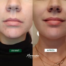 Acne Treat+ Routine - Cleans pores & Treats acne